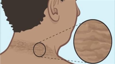  أعراض مقاومة الأنسولين.. 7 علامات يجب الانتباه إليها