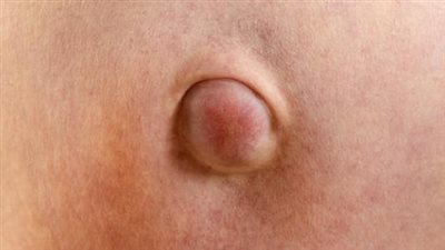 ما لا تعرفه عن الفتق البطني