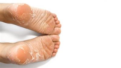 كيفية إزالة الجلد الميت من القدمين: 7 طرق فعالة