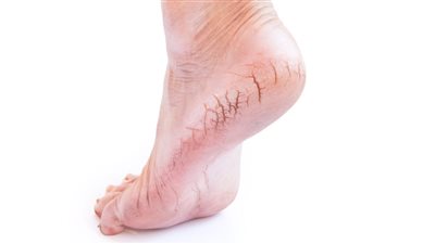 أسباب جفاف وتشقق القدمين والكعبين..  7 عوامل محفزة