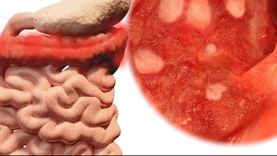 التهاب القولون التقرحي وكيفية تطوره وعلاجاته المتاحة