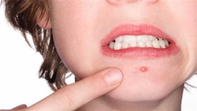 دليلك الشامل لاستخدام الثلج على الوجه.. المدة المسموحة والمخاطر المحتملة