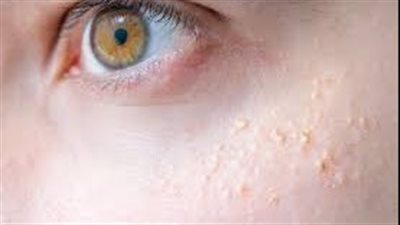 احذر.. العيش على نوع معين من الطعام يمكن أن يسبب العمى