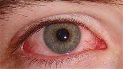 ما هي خطورة ارتفاع ضغط العين والزرق؟