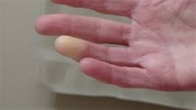 تصلب الجلد.. مرض جلدي مزمن يندرج ضمن أمراض المناعة الذاتية 