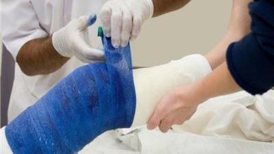 دراسة حديثة تكشف أن التمارين الرياضية تسرع شفاء العظام المكسورة