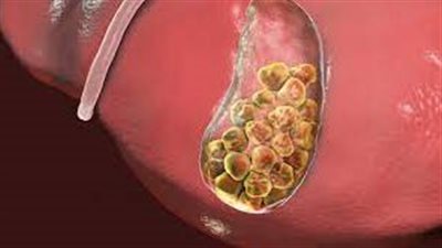 أسباب تعرفها حول الإصابة بالحصوات الصفراوية
