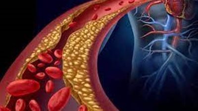 هل الشوكولاتة فعالة في خفض نسبة كوليسترول الدم؟.. دراسة تُجيب