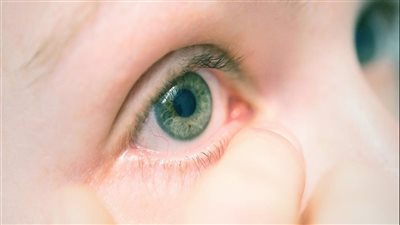 الأطفال أكثر عُرضة للإصابة بالتهاب ملتحمة العين (الأسباب)