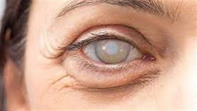 يجب حماية العين من الاهتزازات بعد الجراحة (الاسباب)