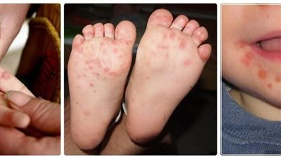 ما لا تعرفه عن مرض اليد والقدم والفم لدى الأطفال