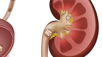 5 علامات تؤكد الإصابة بحصوات الكلى والحالب