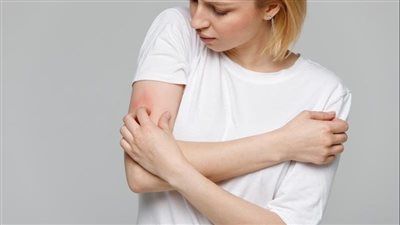 هكذا يمكنك معالجة هذا الطفح الجلدي عند الإصابة بـ 