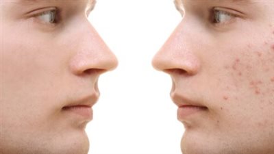 دراسة جينية خاصة بحب الشباب تحدد 29 منطقة من الجينوم تؤثر على حالة الجلد