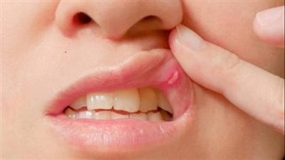 كيفية تسريع التئام تقرحات الفم المؤلمة