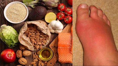 احذر..أطعمة ينبغي على مرضى النقرس تجنبها