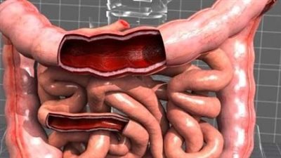 خبيرة تغذية تكشف الحمية المناسبة لمرضى القولون العصبي