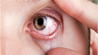 كل ما تريد معرفته حول سرطان العين