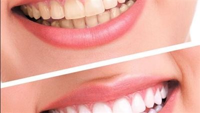 كم من الوقت يدوم تبييض الأسنان؟