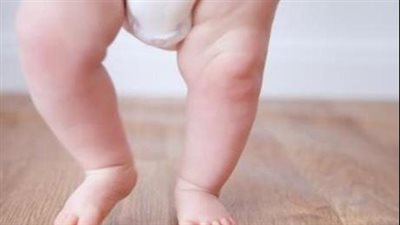 احذر.. عرج الأطفال ينذر بهذه المتلازمة