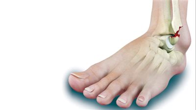 بشرى سارة.. تقنية تساعد على التئام كسور العظام