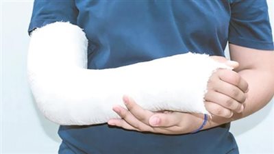 باحثون يطورون وسيلة علمية جديدة لعلاج الكسور