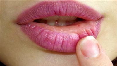  أسباب ظاهرة جفاف وتشقق الشفاه المنتشرة