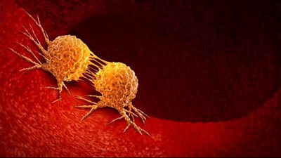 أكبر سبب فردي للسرطان يمكن الوقاية منه بعد التدخين