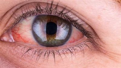 العلامات الشائعة للسرطان التي تظهر في العينين