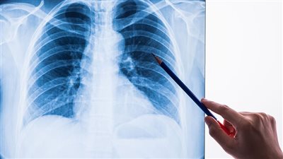 باحثون: داء السل أخطر من كورونا 