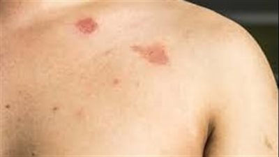 معلومات لا تعرفها حول مرض النخالية المبرقشة (الأسباب وطرق العلاج)