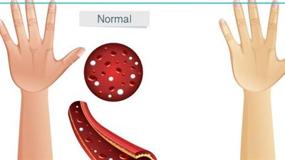 إحذر.. الأنيميا لها تأثير كبير على صحة الجسم 