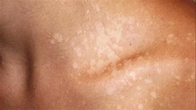 ما هي العوامل التي تهدد بالإصابة بمرض 