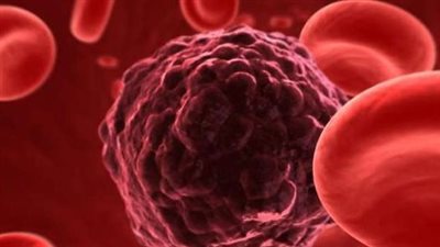 أبرز الأعراض التي قد تشير إلى الإصابة بمرض السرطان