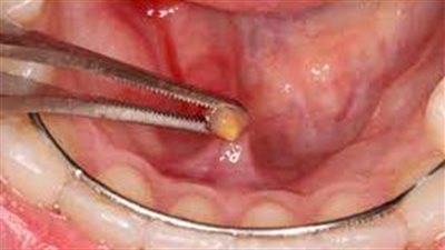 تعرف على أعراض وأسباب الحصوة اللعابية