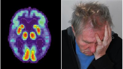لن تصدق.. مفتاح وقف مرض الزهايمر