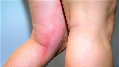 تعرف على أعراض تجلط الدم في الرجل