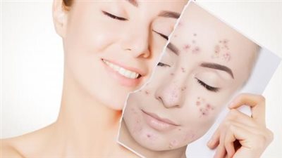 موجودة بالفعل في المنزل... منتجات منزلية طبيعية يمكن استخدامها لعلاج حب الشباب!