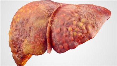 كل ما تريد معرفته حول الإصابة بتشمع الكبد