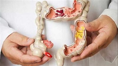 هكذا يمكنك الوقاية من سرطان القولون والمستقيم إلى حد بعيد