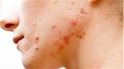  للعناية بالبشرة.. خبيرة تجميل إسترالية تكشف طريقة مختلفة للعلاج بالنبض الضوئي الليزري