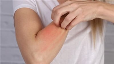 ما هي الأدوية التي أكثر من غيرها تسبب عادة الحساسية؟