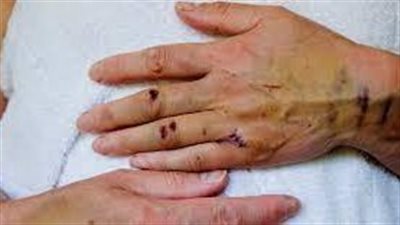 عادة ما تتماثل الجروح للشفاء ببطء لدى كبار السن. فما أسباب ذلك؟ 