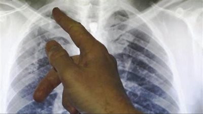 الكشف العلاقة الرابطة بين هشاشة العظام وتصلب الشرايين.. بالاعتماد على المومياوات