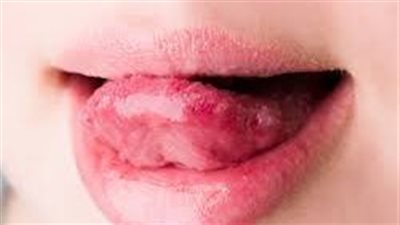 حرقة اللسان لها أسباب عدة.. ما هي؟