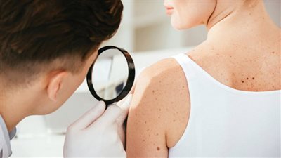 الكشف سبب الإصابة بسرطان الجلد الفاتح