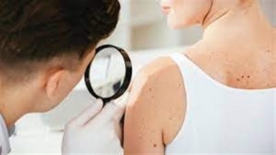  السبب الرئيسي للإصابة بسرطان الجلد الفاتح