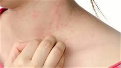 مجموعة من الأمراض الجلدية الأكثر شيوعًا بعد الولادة