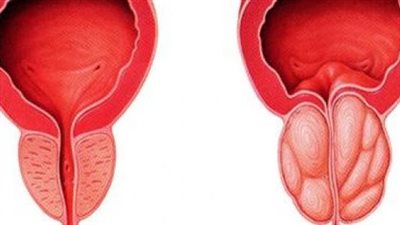 هل هناك طرق مؤكدة للوقاية من سرطان البروستاتا؟