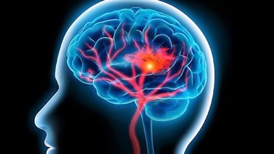 ما هي الأعراض المبكرة للسكتة الدماغية الإقفارية؟